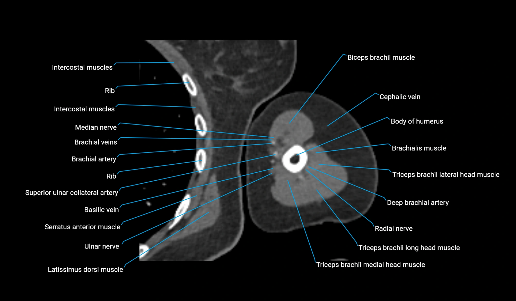 CT upper arm axial  cross sectional anatomy labelled radiology image -00242.webp